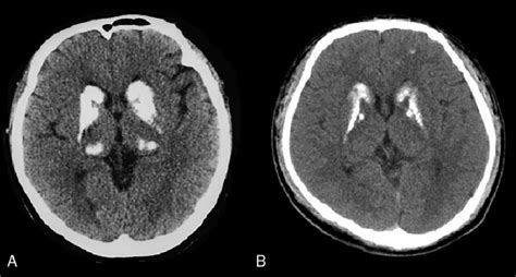 Head CT of the patient and her son showing calcification of basal ...