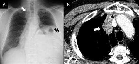 Phrenic Nerve Reconstruction and Bilateral Diaphragm Plication After ...