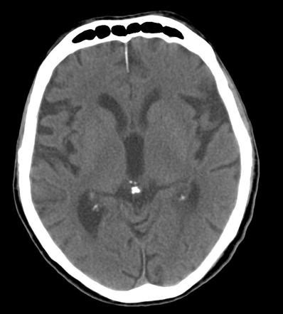 Pineal gland calcification | Radiology Case | Radiopaedia.org