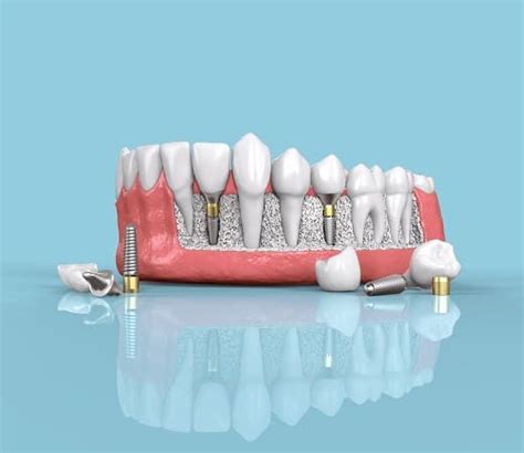 Dental Bone Loss Seattle - Dental Bone Loss Treatments Seattle