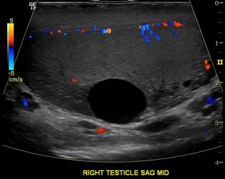 Testicular cyst | Radiology Case | Radiopaedia.org