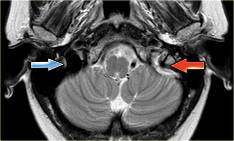 The Radiology Assistant : Cerebral Venous Sinus Thrombosis