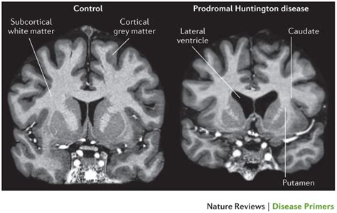 Huntington Disease (HD) - Stepwards