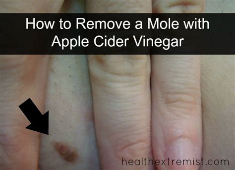 My Apple Cider Vinegar Mole Removal Experiment Worked!