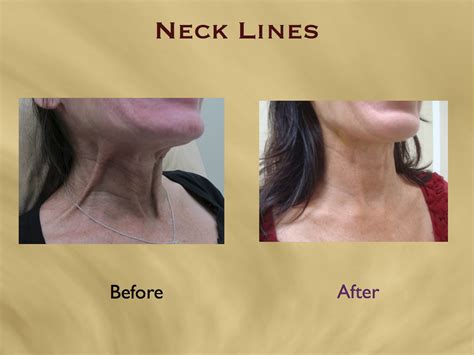 Nefertiti Lift and Neck Wrinkle Smoothing with Botox - Aesthetics Hawaii