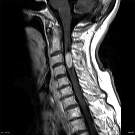 Spinal ependymoma | Radiology Reference Article | Radiopaedia.org