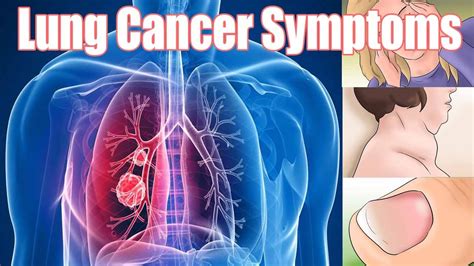 10 Symptoms of Lung Cancer