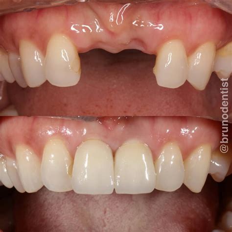 Replacement of 2 missing front teeth with dental implants and zirconia crowns. # ...