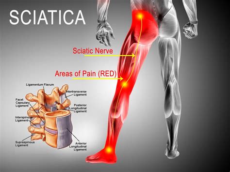 Suplemen Untuk Sakit Saraf Sciatica