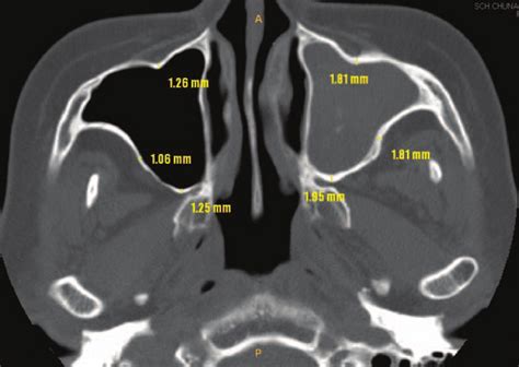 Anterior Wall Of Maxillary Sinus