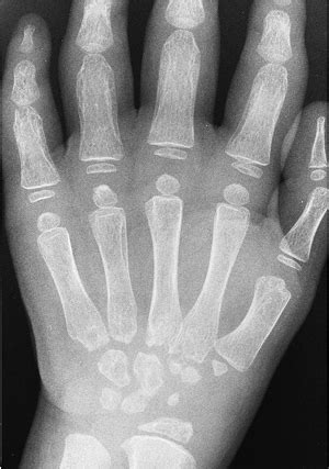 Juvenile Rheumatoid Arthritis - Causes, Symptoms, Treatment, Prognosis | HealthMD