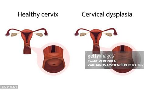 Cervical Dysplasia Photos and Premium High Res Pictures - Getty Images