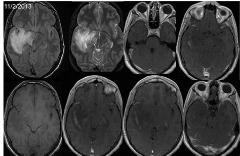 tumefactive multiple sclerosis