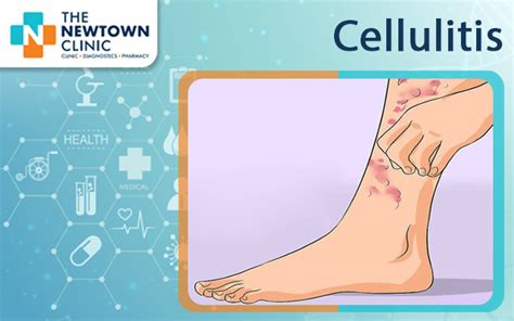 Cellulitis - Symptoms and Causes - The Newtown Clinic