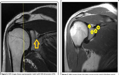 Suprascapular Nerve Entrapment Mri