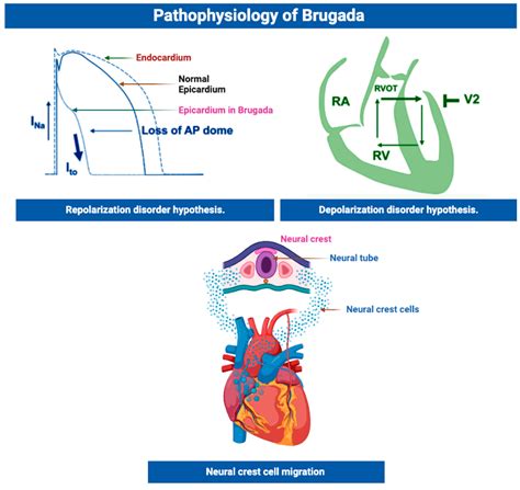 Cells | Free Full-Text | Genetic and Molecular Mechanisms in Brugada ...