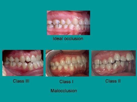 class i ii iii occlusion - Big League Memoir Picture Galleries