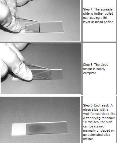 Wedge slide technique for preparation of a peripheral blood smear | Medical Laboratories