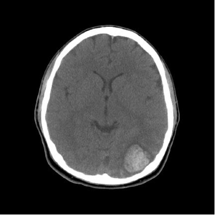 Brain Aneurysm Ct Scan - Diagnosis of a brain aneurysm may require ct scans, lumbar puncture, or ...