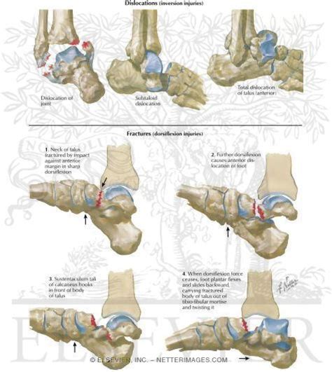 Fractures and Dislocations of Talus