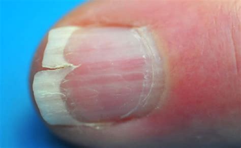 Split Fingernails (Onychoschizia): Symptoms, Causes & Remedies