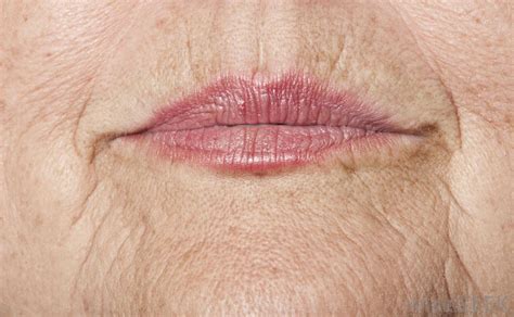 Why are women more prone to lip wrinkles than men? - Facial Acupuncture Classes