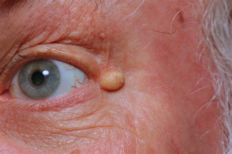 Epidermoid Cyst, Infected - Causes, Symptoms,Treatment