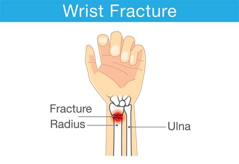 Distal Radius Fracture: Signs, Symptoms, Causes, and Treatment Options