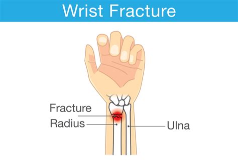 Ulnar Wrist Bone