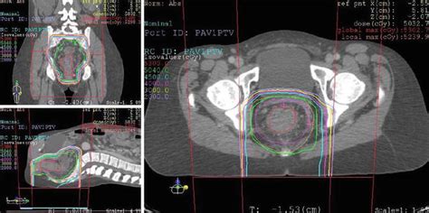 Rectal and Colon Cancer: Radiation Therapy Planning | Abdominal Key