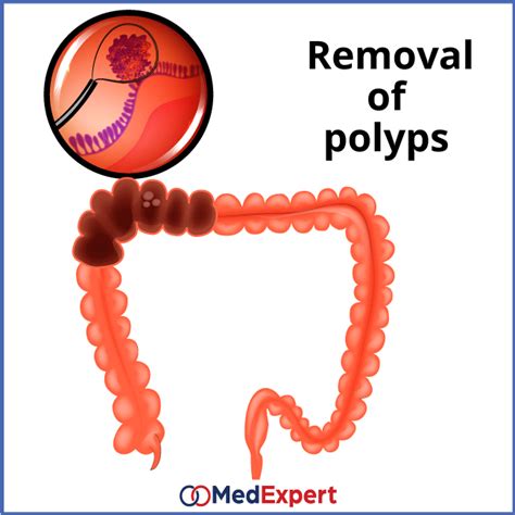 Colon polyps treatment, symptoms and diagnostics services | MED Expert