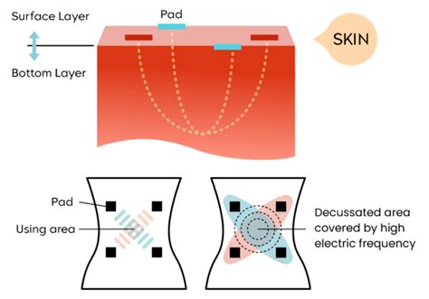 What Is Interferential Current – Everything You Need To Know