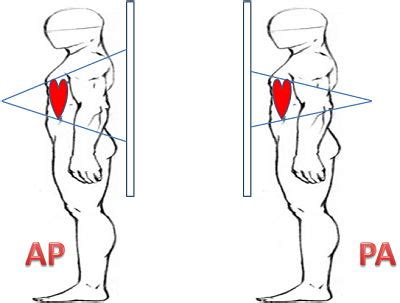 AP chest x-ray versus PA chest x-ray - Critical Care Practitioner