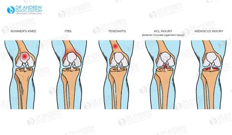 Arthroscopy or Keyhole Surgery for ACL & Meniscal Injuries | Dr. Dutton