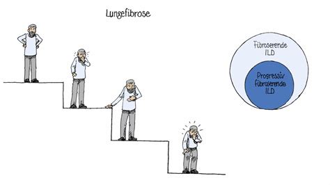 About Interstitial Lung Diseases (ILD) | Boehringer Ingelheim Norway