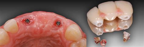 How to Achieve Success with Custom Zirconia Abutments - Spear Education