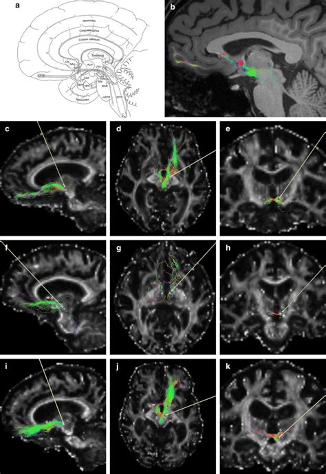 Schematical drawing and fiber reconstructions of the medial forebrain ...