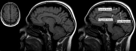 Radiological Anatomy: Central Sulcus - Stepwards