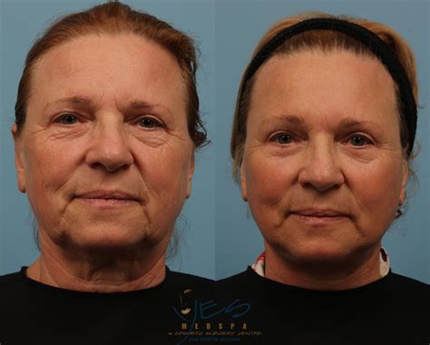 Lower Eyelid Blepharoplasty Before & After Photos Patient 150 | Vancouver, BC | YES Medspa ...