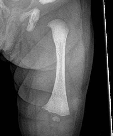 Metaphyseal corner fracture | Radiology Case | Radiopaedia.org