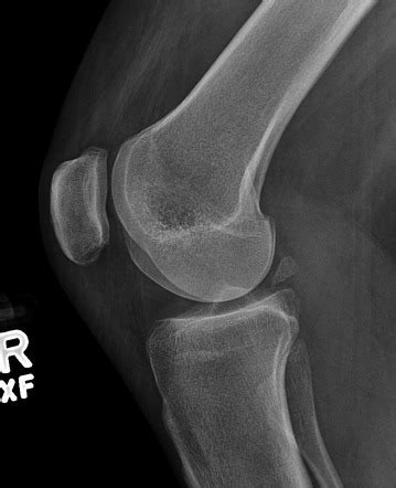 Knee (lateral view) | Radiology Reference Article | Radiopaedia.org