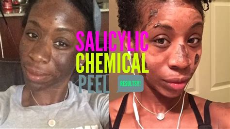 Salicylic Acid Skin Peel At Home at Brenda Henry blog