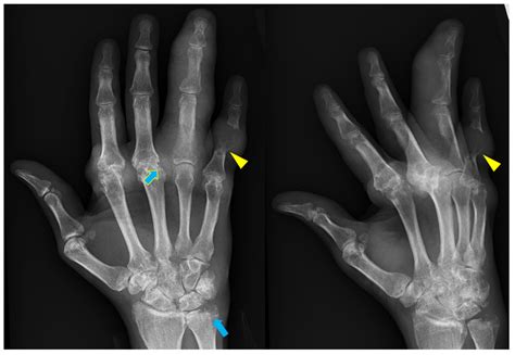 Rheumatoid Arthritis X Ray