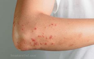 What Is Hives (Urticaria) | Symptoms, Causes,Treatment & Drugs » How To Relief