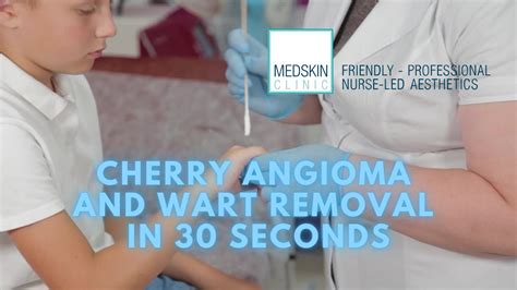 Cherry Angioma Removal Treatment 60 Seconds No-Pain Freezing ...