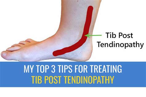 Tibialis Posterior Tendonitis Exercises | Porn Sex Picture