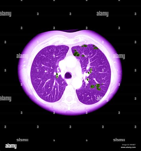 Ct de copd Banque de photographies et d’images à haute résolution - Alamy