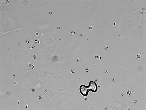 File:Calcium oxalate crystals (urine) - kalsiyum oksalat kristalleri (idrar) - 01.png