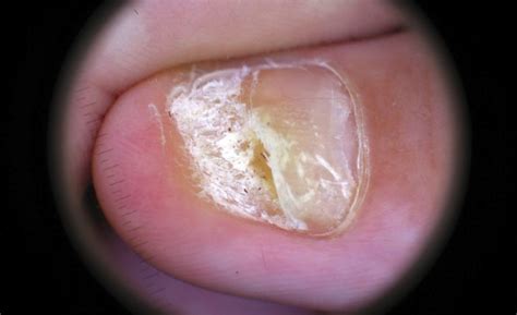 Chronic Pain in Pachyonychia Congenita May Be Neuropathic in Nature - Dermatology Advisor