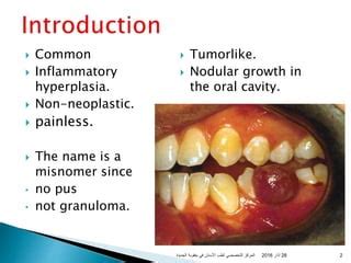 Oral pyogenic granuloma | PPT